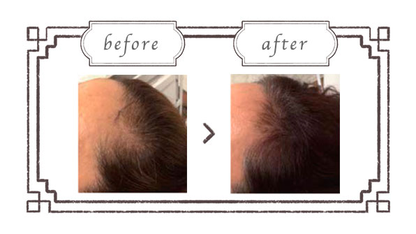 ヒト幹細胞培養液の頭⽪マッサージ|エステサロン六甲道 ヒト幹細胞培養液の頭⽪マッサージ