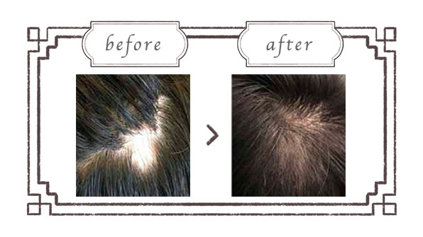 ヒト幹細胞培養液の頭⽪マッサージ|エステサロン六甲道 ヒト幹細胞培養液の頭⽪マッサージ